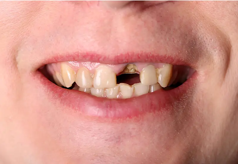 Dental treatment before